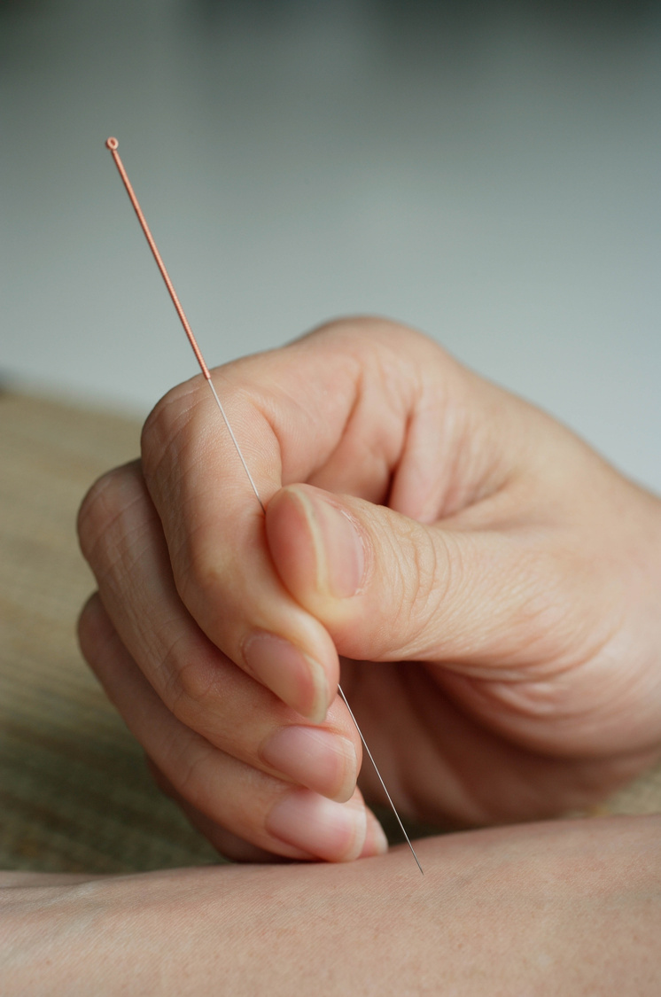 Chinese Accupuncture Treatment